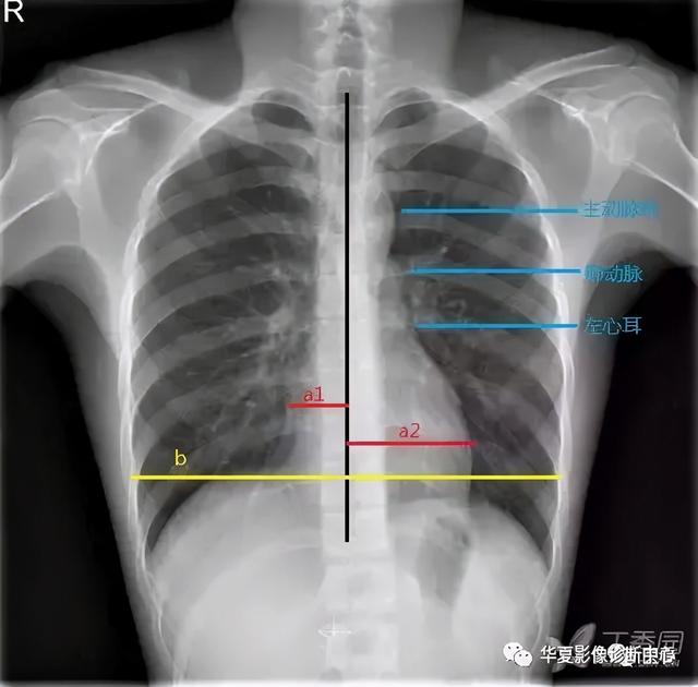 胸部平片中心影这样看，再也不怕难