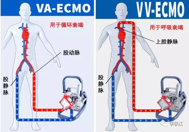 不同情况下成人体外膜肺氧合临床应用专家共识（2020版）发布