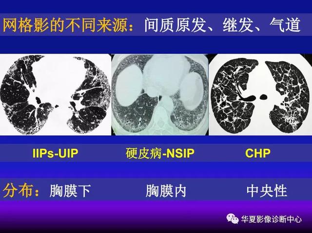 肺间质性疾病的解剖、病理、影像分析