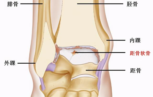什么是距骨骨软骨损伤？