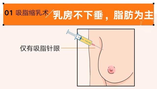 各类人群的乳房缩小术