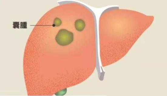 肝囊肿|体检报告上的肝囊肿，究竟是不是肿瘤？
