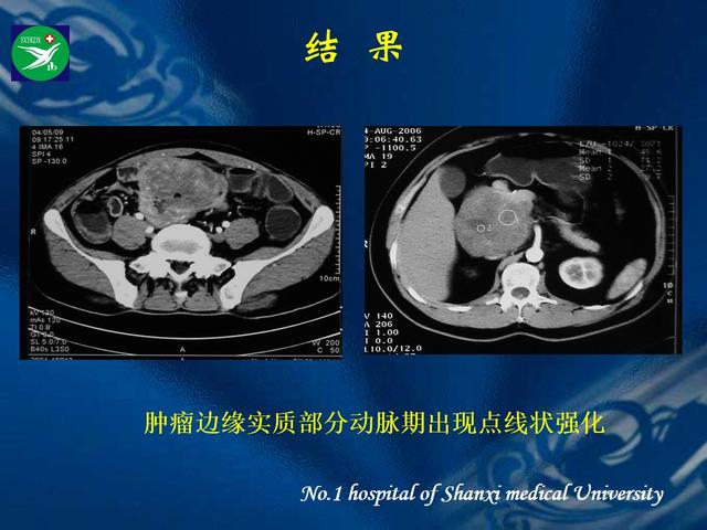 李健丁教授：胃肠道外间质瘤的CT表现和临床病理分析