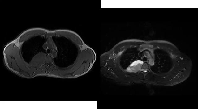 6种常见纵隔肿瘤的影像解读与鉴别要点，一文击破