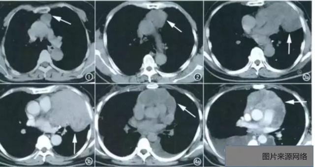 6种常见纵隔肿瘤的影像解读与鉴别要点，一文击破