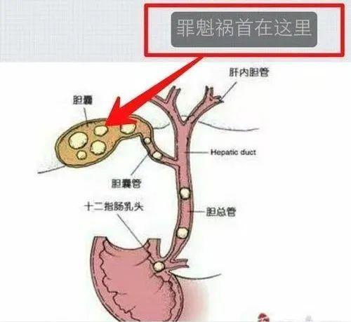 结石|不要被“假胃痛”骗了！有些疾病披着“胃痛”外衣，其实很凶险