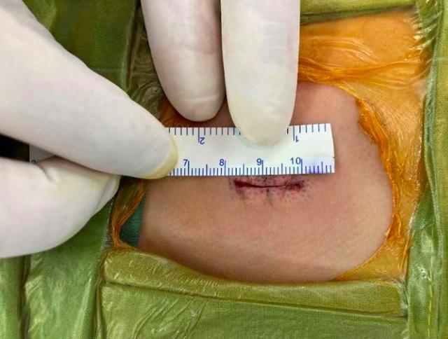 手术|小切口，好疗效，上海儿童医学中心成熟开展神经内镜辅助下极小切口脊髓栓系手术