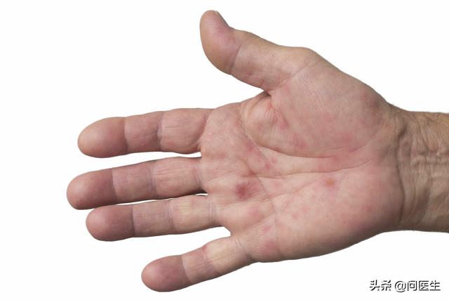 手指甲经常粗糙且无光泽是肝脏不好？肝脏好不好，看手也能知道