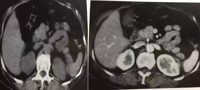 胰腺占位 CT 片不会看？这里一文教你掌握