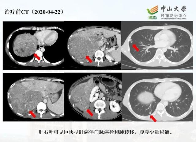 名医说肿瘤｜31岁男子患晚期肝癌肺转移，4个月后奇迹发生…