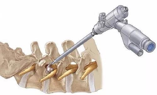 椎间孔镜|为什么颈椎病，肩膀疼痛会引起手臂麻木呢？在家要如何缓解
