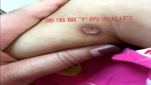 你的育儿经■千万注意！只因被它咬了一口，8岁女童多器官损伤