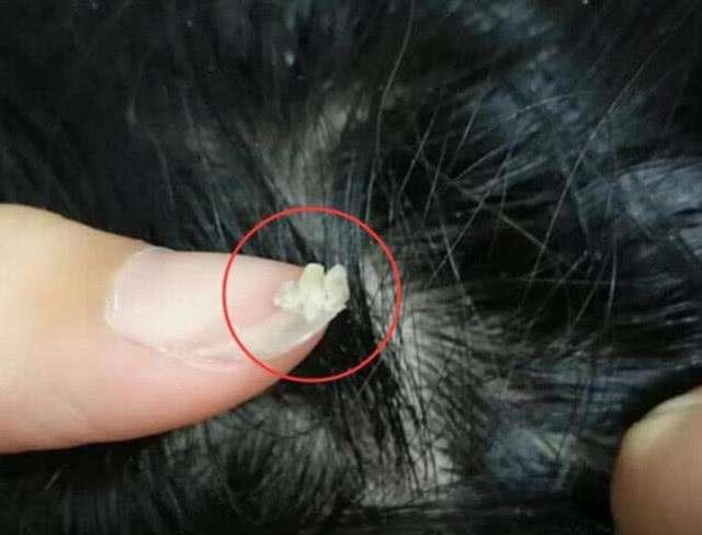 超级宝妈▲妈妈发现女儿头上有小米粒，医生：再晚点来就秃了