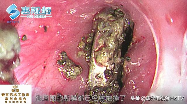 超级宝妈▲3岁小孩误吞纽扣电池 2小时食道已被腐蚀烧黑