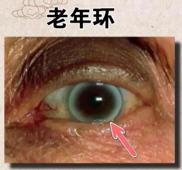 血脂异常的蛛丝马迹，在身上的这些地方就可以找到