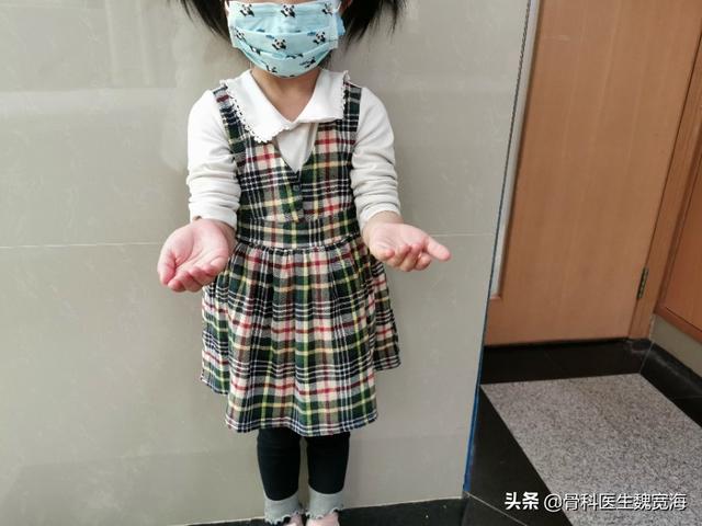 「超级宝妈」小孩骨折一定要防止漏诊（陈旧性孟氏骨折）