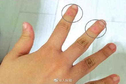 手指|警惕！12岁女孩爱啃手指啃至变形