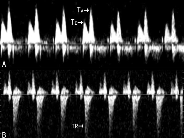 你的育儿经|明明白白做超声24-1:胎儿早期非整倍性染色体疾病筛查2
