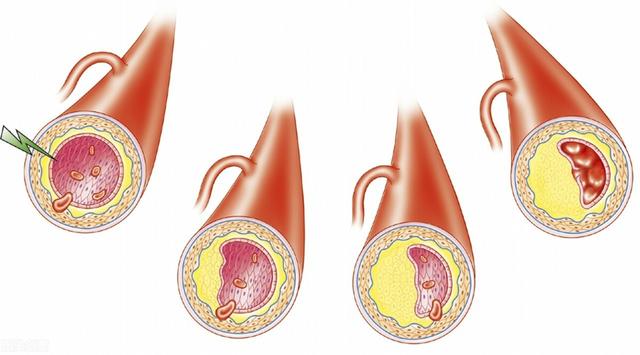 低密度脂蛋白升高，就是血管堵了吗？辟谣：为你说清如何预防风险