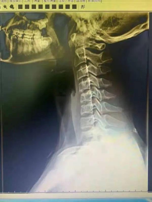 孩子|拿什么拯救孩子的颈椎？