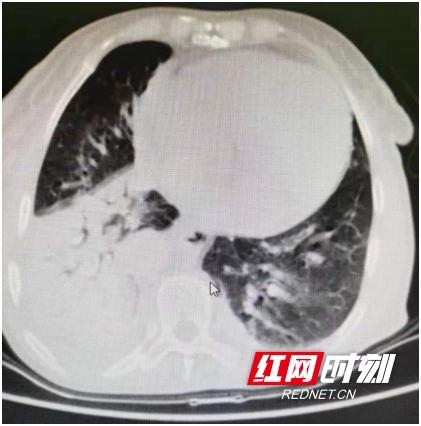 频繁发热治不好“罪魁祸首”竟然是它