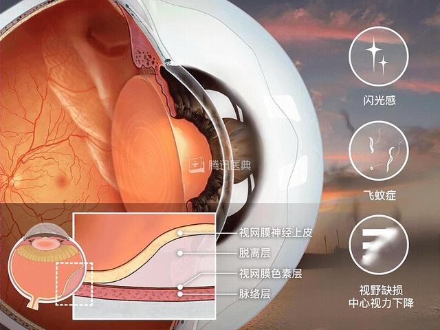 困扰艾芬医生的视网膜脱离，有3类人要格外留心
