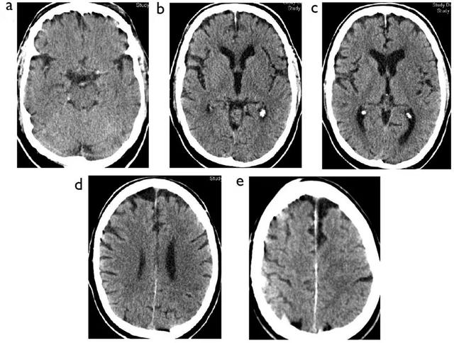 脑梗死患者的头部CT，你真的会看吗？丨实战读片