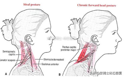 肌肉疲劳|「体态矫正」慢性颈肩痛，或许与你有头前伸的不良体态有关