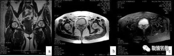 10种类似股骨头坏死的髋关节疾病的鉴别诊断