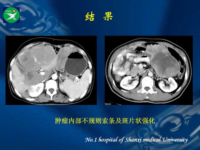 李健丁教授：胃肠道外间质瘤的CT表现和临床病理分析