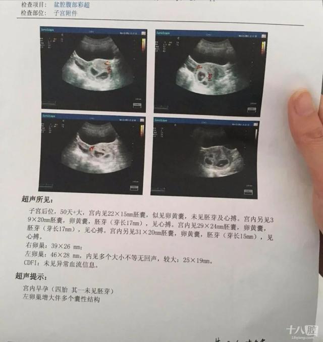 #你的育儿经#浙江男子带老婆做孕检,一查肚子里竟有4个...网友算了笔帐,一般人真不知道