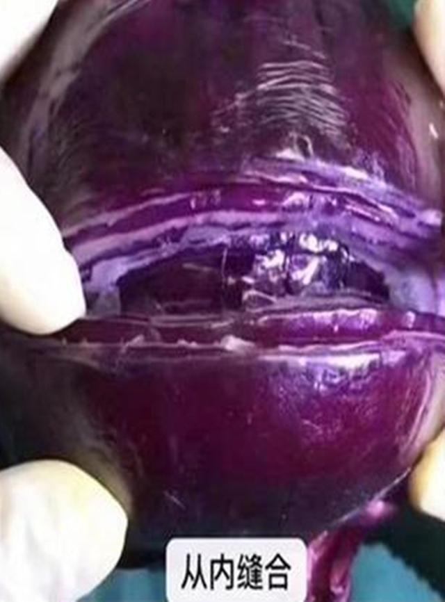 你的育儿经|选剖腹产不疼？这根10厘米的麻醉针仅仅是开始，疼到你怀疑人生