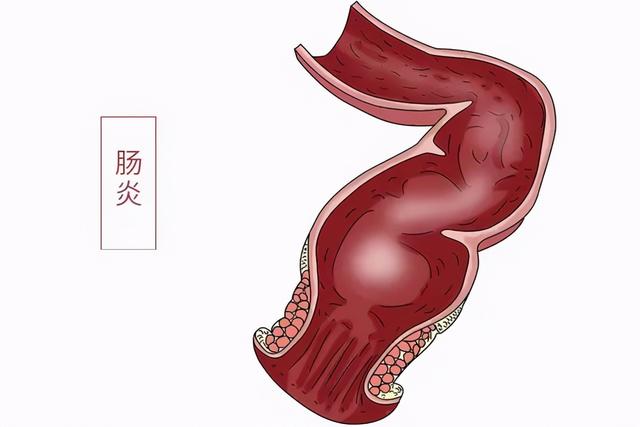 为啥说癌症大多是拖出来的？医生：3种炎症拖久了，迟早恶变为癌