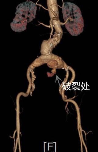 大爷|81岁大爷腹部剧痛，原来是主髂动脉瘤破裂 医生：这种病死亡率高达70%以上