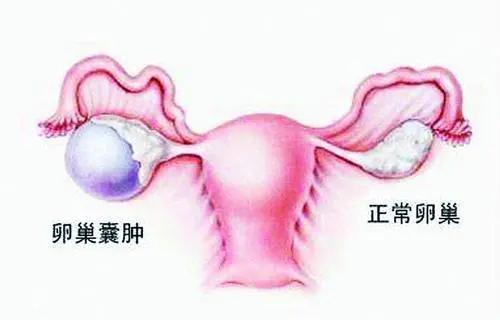 超级宝妈|年轻孕妈遭遇卵巢囊肿，保大还是保小？张翠菊：全保！！