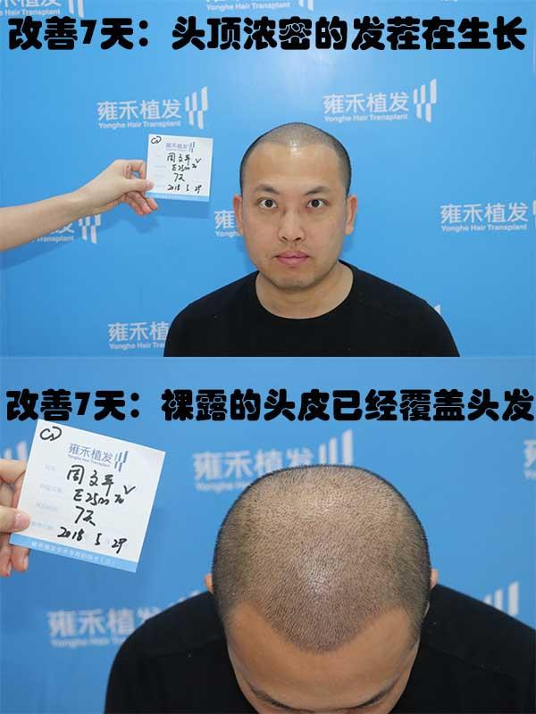 非那雄胺的真实有效率是多少（五位发友改善一年，终于告别稀疏）