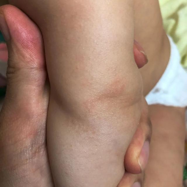 超级宝妈▲这种湿疹，很容易被当成痱子，越治越坏
