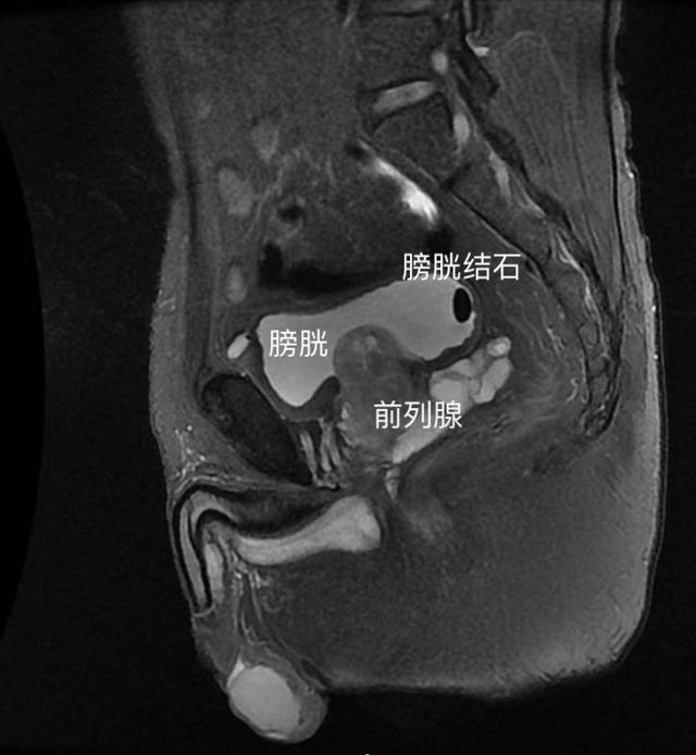 前列腺增生的五大常见误区，如何避坑？泌尿外科医生告诉你