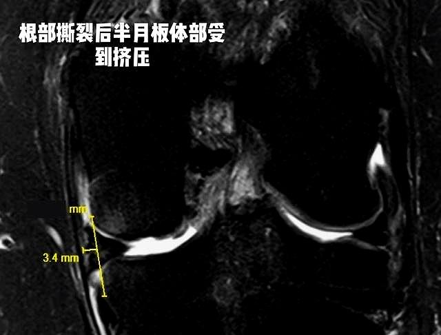 为什么半月板撕裂后，膝盖会“滋啦”响？该咋办，医生给您讲清楚