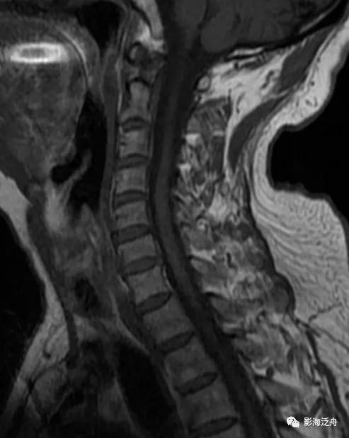 典型病例——颈椎后纵韧带钙化（MR）