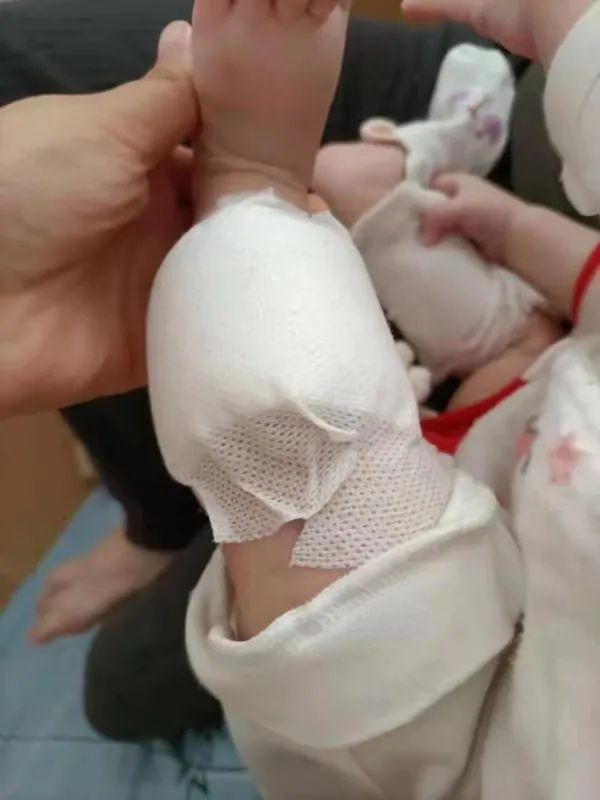 女士|推拿馆做艾灸治疗感冒，银川半岁女婴两条小腿深二度烫伤……