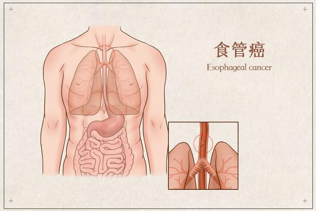 全球食管癌患者中我国占一半，预防食管癌要这么做