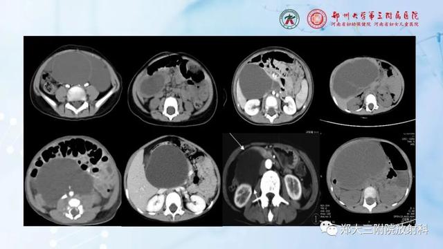 儿童腹部囊性病变诊断思路分析