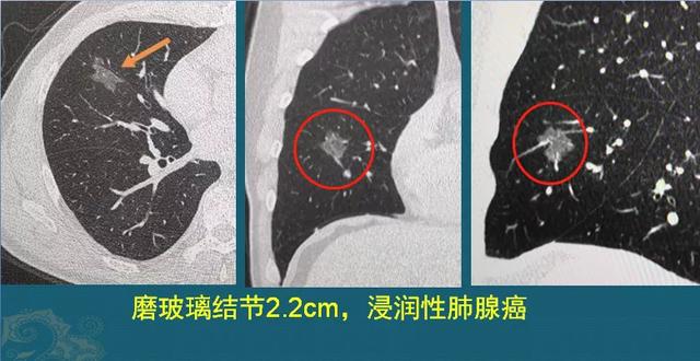 磨玻璃结节就是肺癌吗？