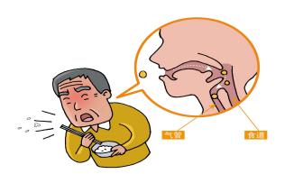 「康复馆」中风后吞咽困难的针灸治疗