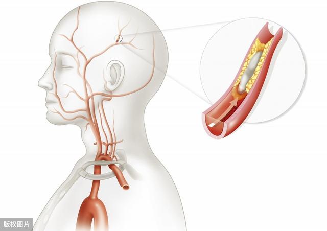 30%的脑梗死和颈动脉斑块有关，坚持做好斑块防治刻不容缓