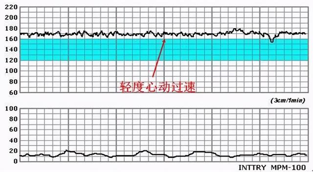 宝妈健康小贴士：怎样做胎心监护更容易过关？准妈妈快收藏