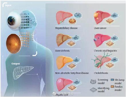 肝胆|通过眼睛就能筛诊肝胆疾病