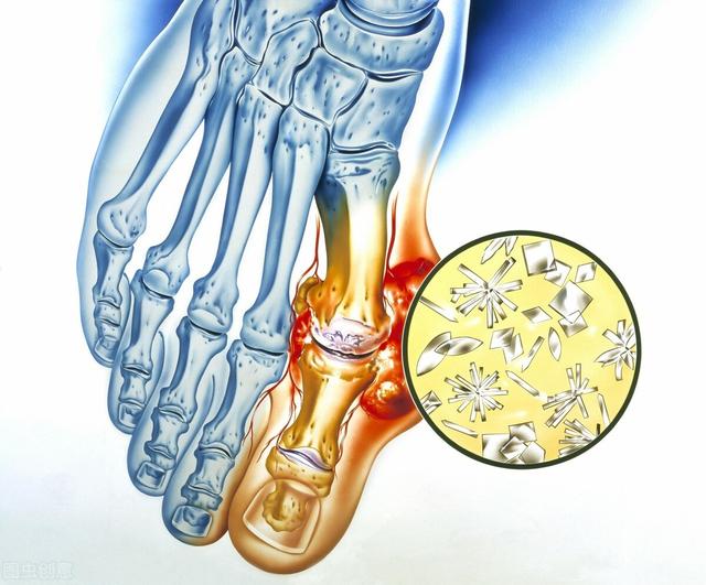 非布司他起效快、效果好？真是这样吗？一次说清