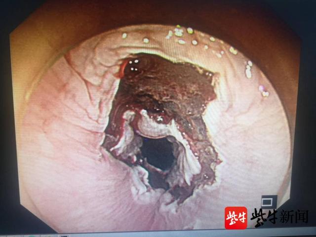 病变|食管粘膜“瘤变”了！“医林绝技”成功挽救，耄耋老人迎新生